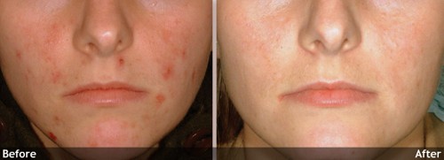treat-pimple-scars-home-remedies